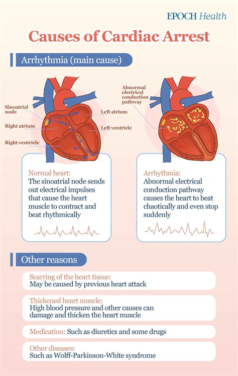 cardiac arrest causes